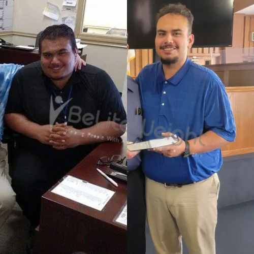 RNY Gastric Bypass Surgery Before and after